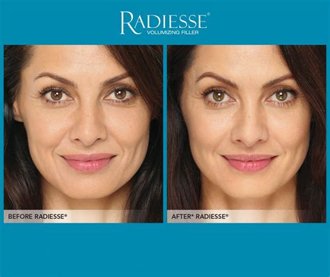 Radiesse® .